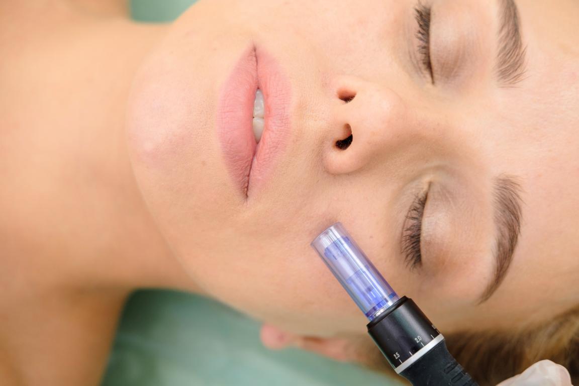 Cosmetologist,Making,Mesotherapy,Injection.,Microneedle,Mesotherapy.,Treatment,Woman,At,Beautician. Microneedling Meso Sono